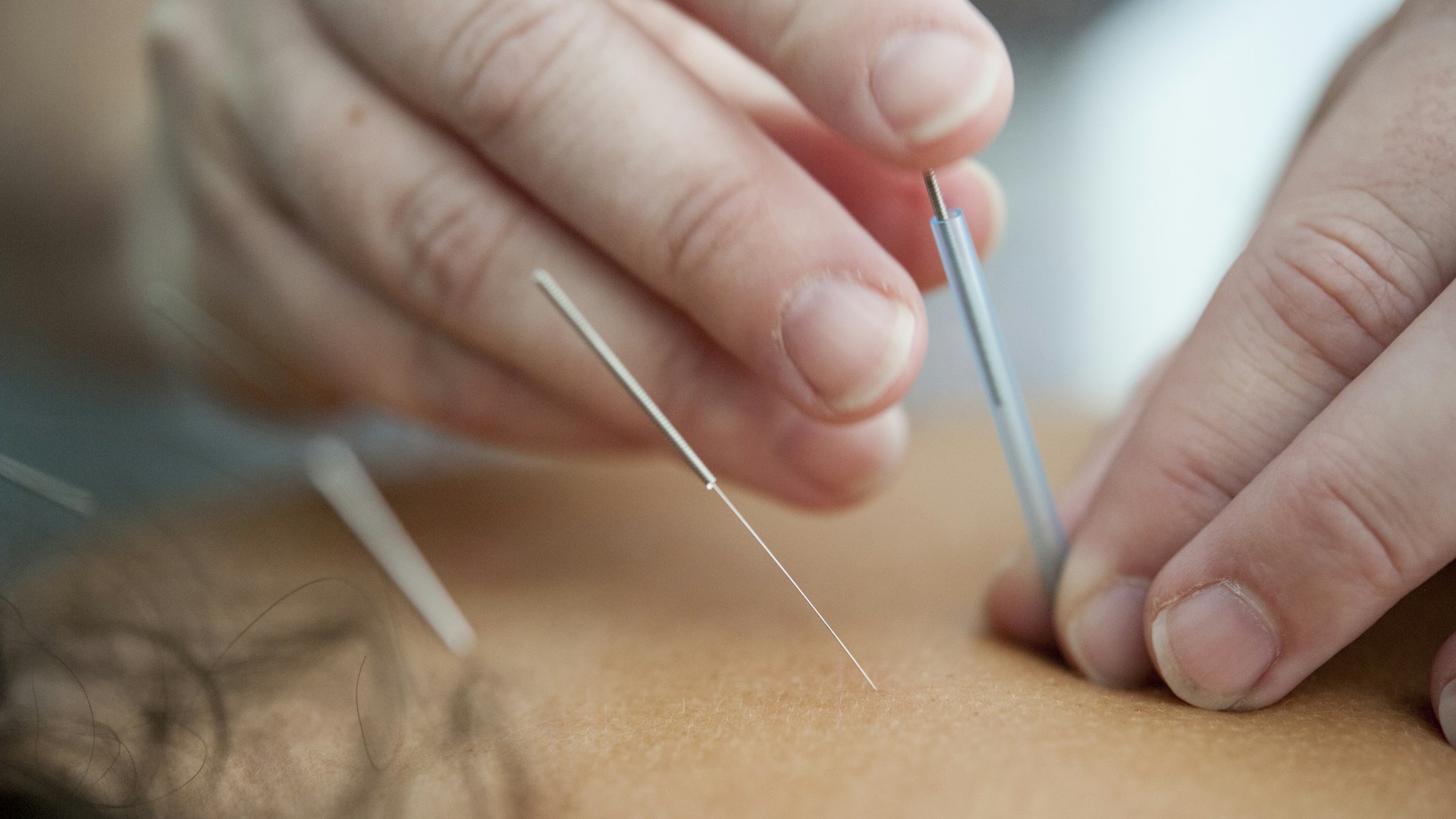 acupuncteur acupuncteur